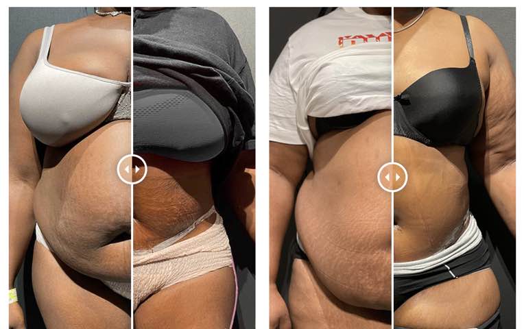 extended tummy tuck before and after