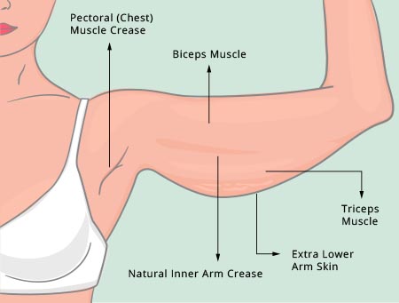 plus size arm lift before illustration