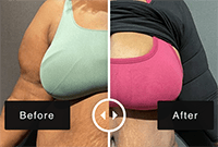 plus size breast reduction gallery