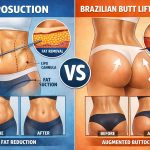 Liposuction vs Brazilian butt lift comparison