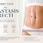 Tummy Tuck For Diastasis Recti