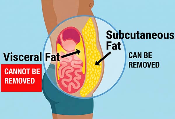 visceral vs subcutaneous illustration